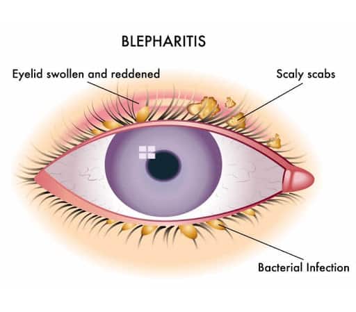 blepharitis