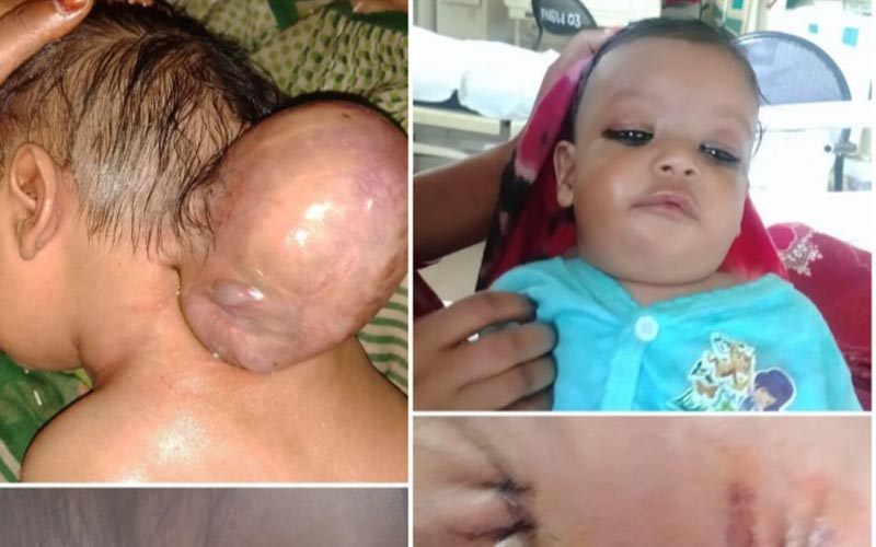 2 headed child saifai medical collage